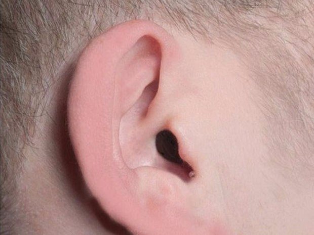 Les types d'appareils auditifs